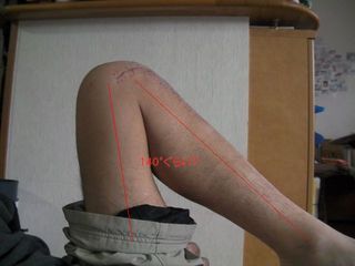 手術後５週後の膝