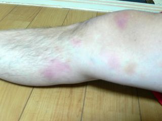 アザだらけだよ